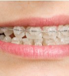 סובלים משיניים עקומות? הכירו את הדרכים שיעזרו לכם להשיג חיוך יפה -תמונה